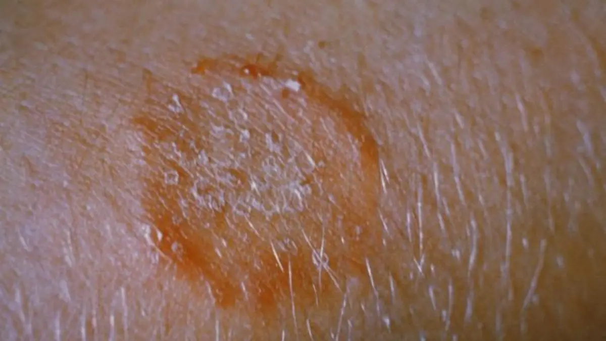 Essential Oils for Ringworm: What the Human Evidence Shows