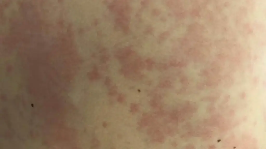 Close view of raised red and pale patches caused by hives