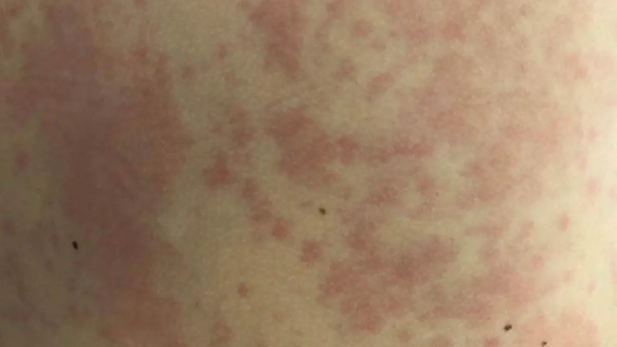 Close view of raised red and pale patches caused by hives
