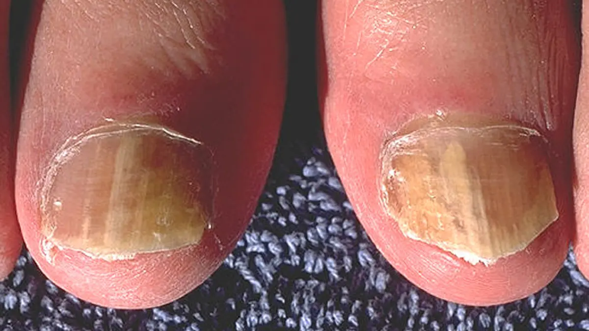 Essential Oils for Toenail Fungus: Tea Tree Evidence and Safety