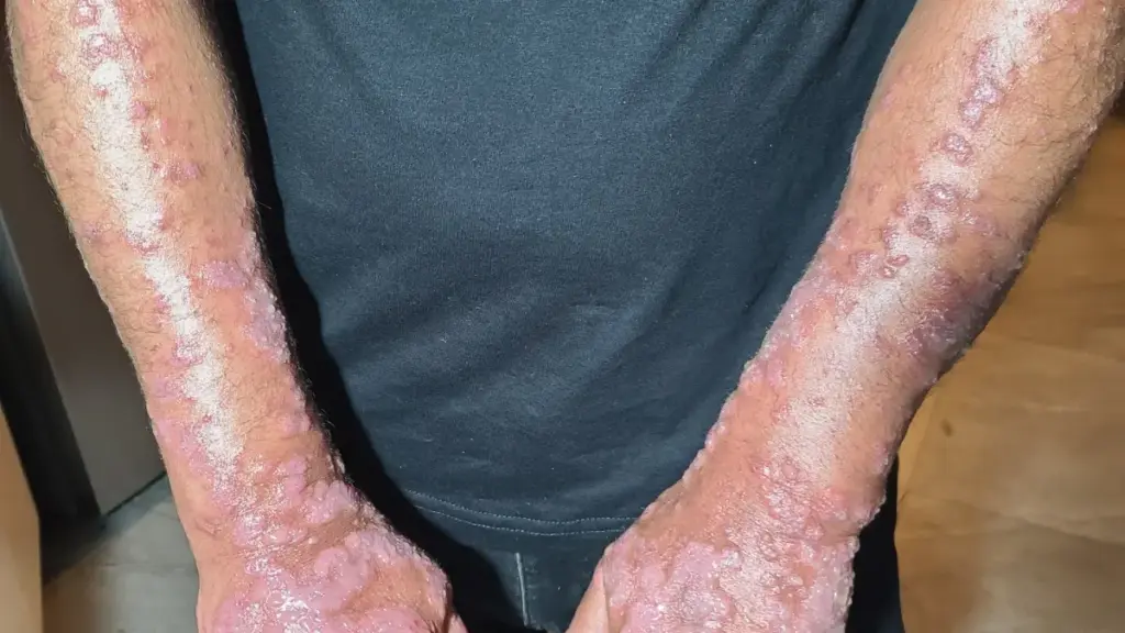Inflamed rash and lesions affecting both forearms