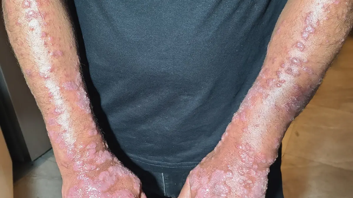 Inflamed rash and lesions affecting both forearms