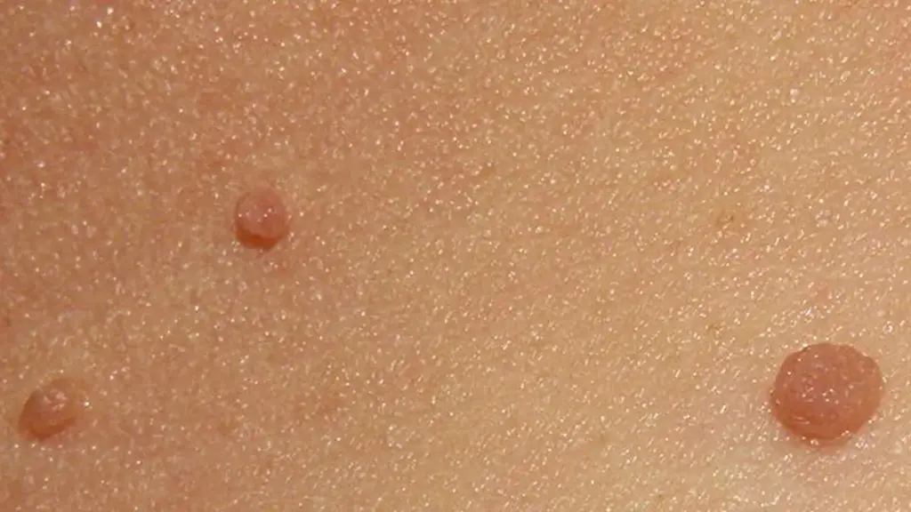 Close view of several small skin tags on the neck