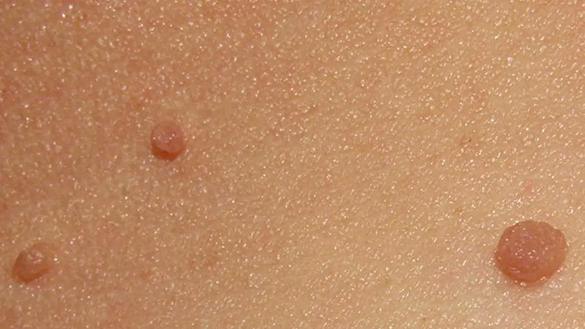 Essential Oils for Skin Tags: Evidence and Removal Risks