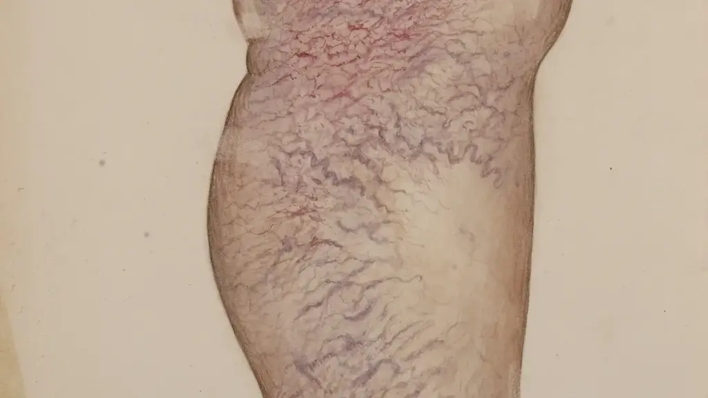 Extensive visible varicose veins on the back of a lower leg