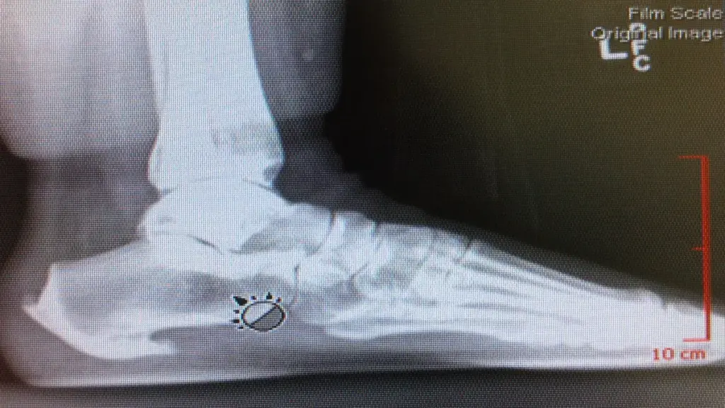 Side-view foot radiograph showing heel bone spurs