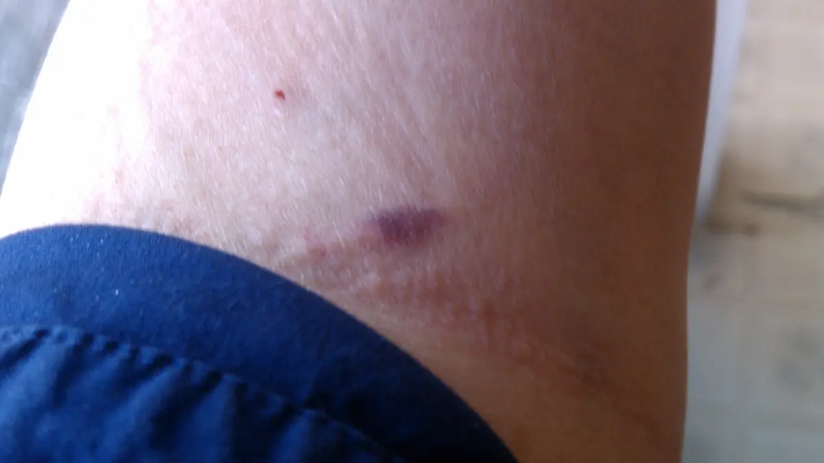 Essential Oils for Bruises: Evidence, First Aid and Warning Signs