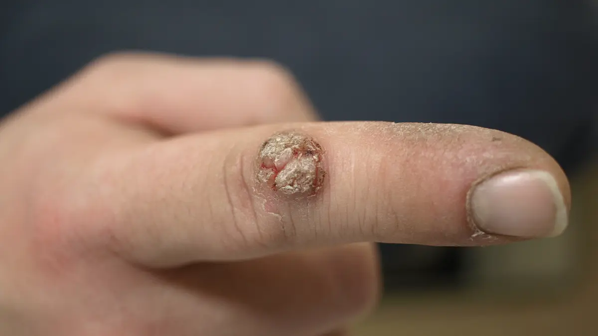 Essential Oils for Warts: Evidence and Safer Treatment