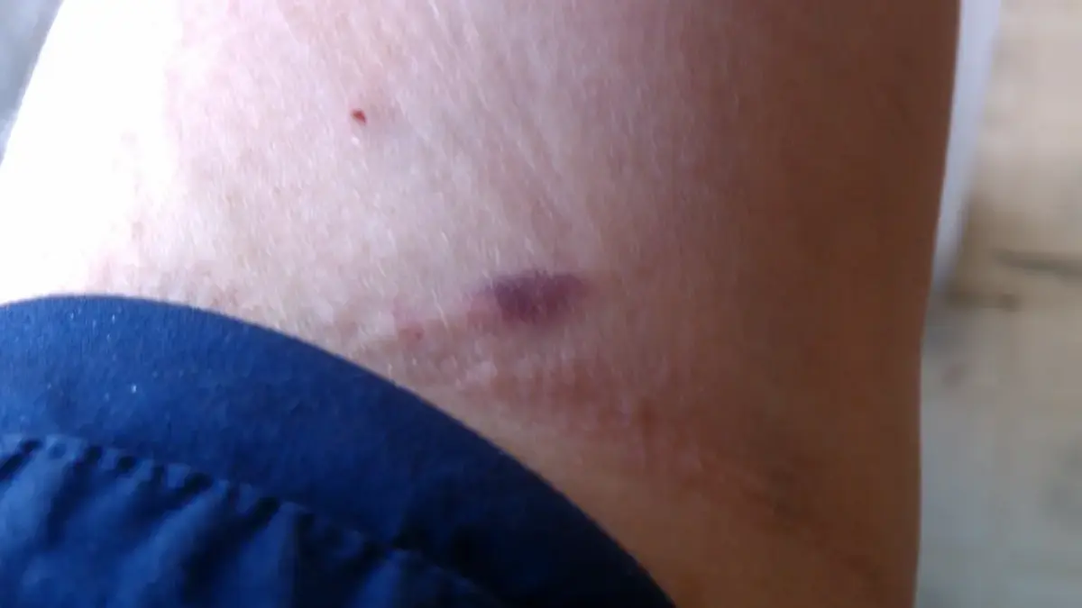 Close photograph of a small bruise on an upper arm