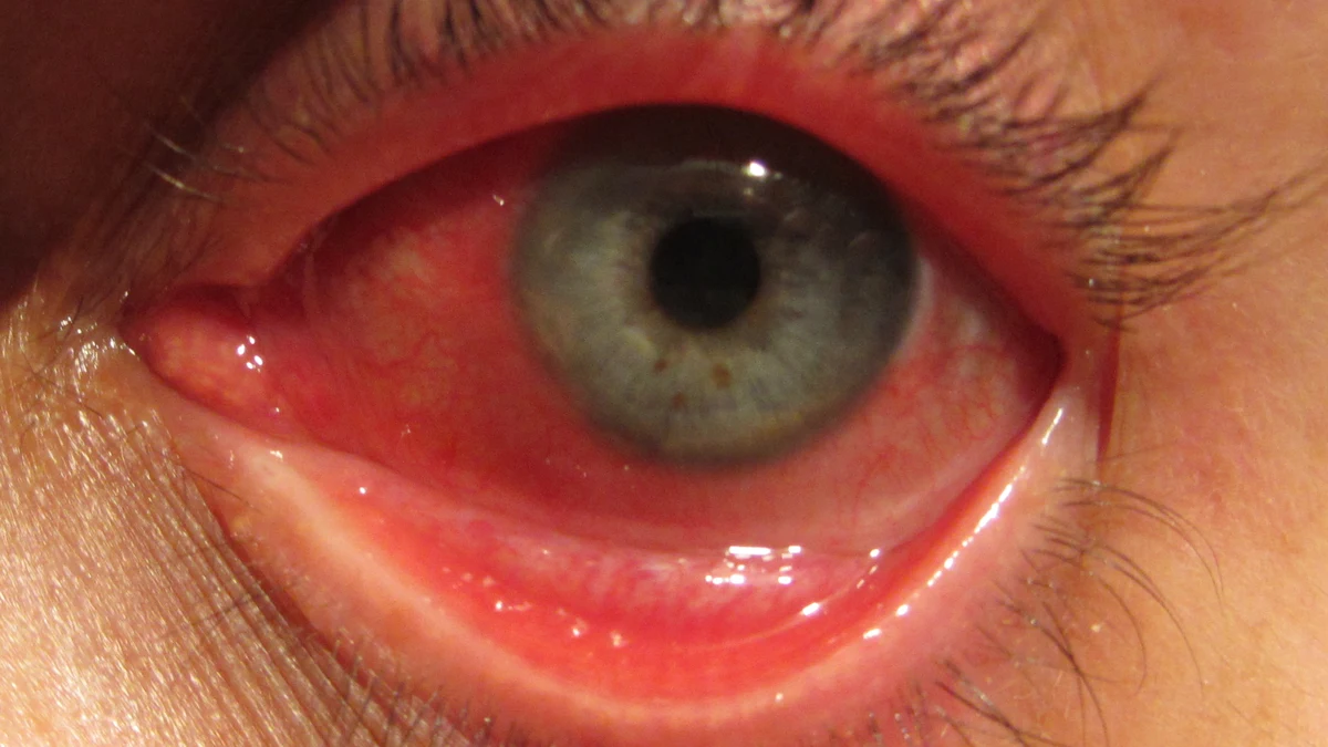 Close-up photograph of a red eye documented as conjunctivitis