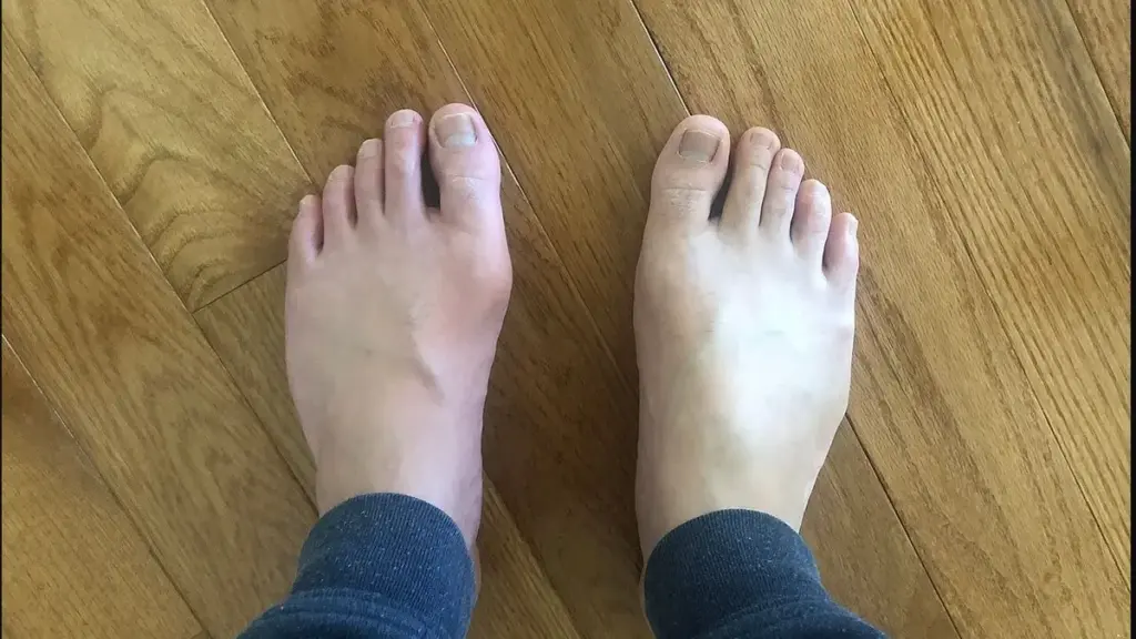 Photograph comparing a swollen big-toe joint during gout with the other foot