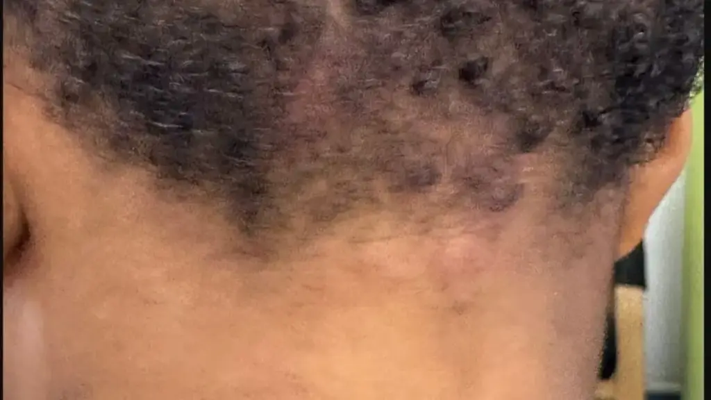 Back of a neck in a photograph labelled cervical lymphadenopathy by its photographer; neck lumps need assessment