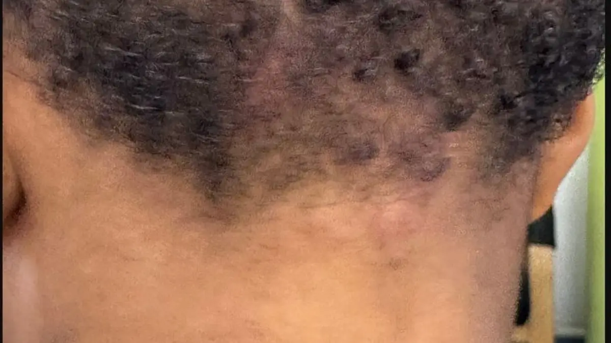 Back of a neck in a photograph labelled cervical lymphadenopathy by its photographer; neck lumps need assessment