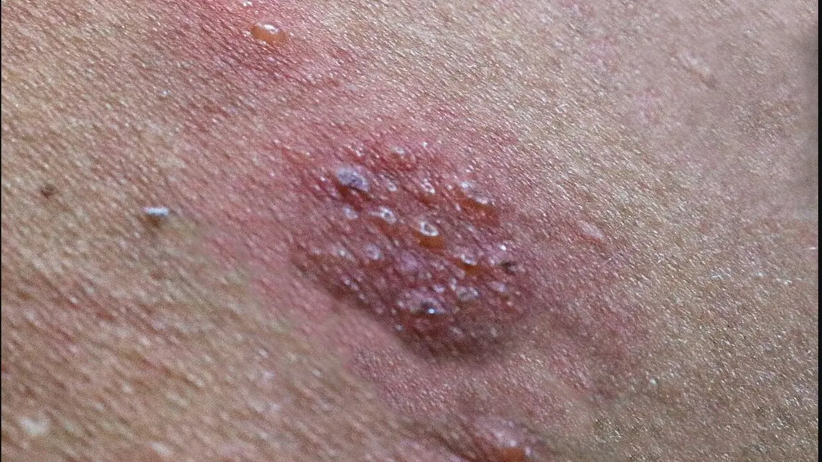 Clinical photograph of a shingles rash; seek prompt medical advice about antiviral treatment