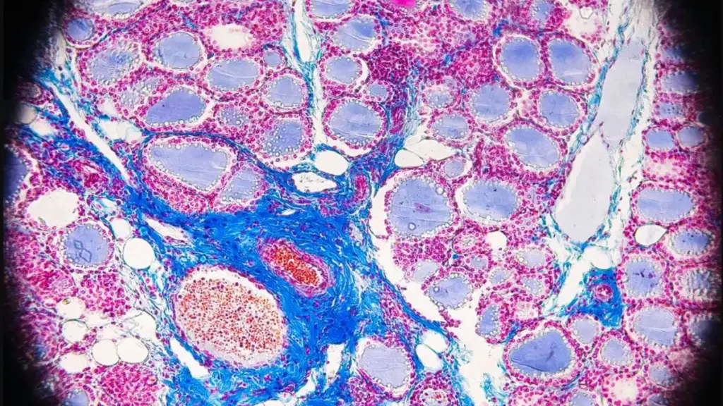 Microscope photograph of stained thyroid-gland tissue; it does not diagnose thyroid disease