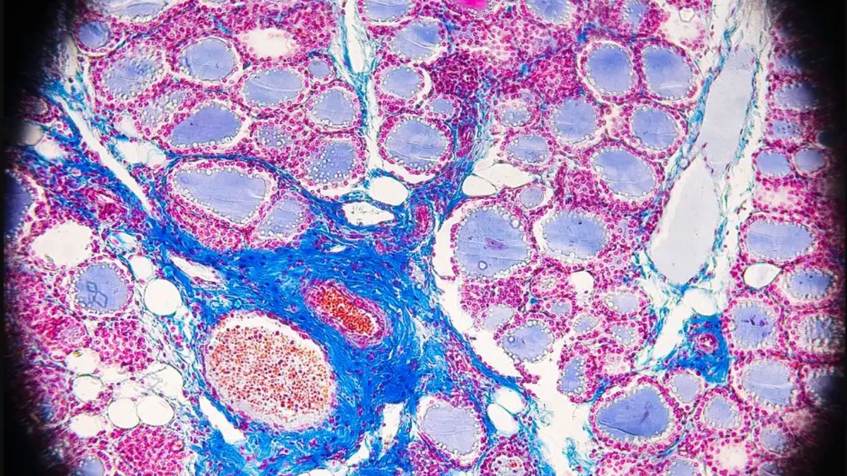 Microscope photograph of stained thyroid-gland tissue; it does not diagnose thyroid disease