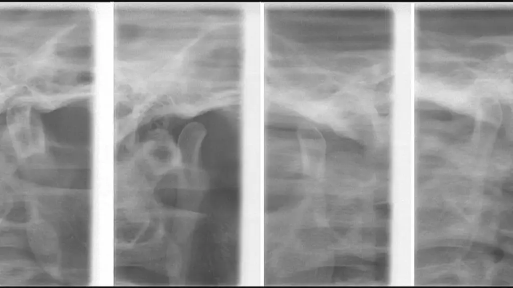 Four radiographic views of the temporomandibular joints; jaw pain needs a cause-specific assessment